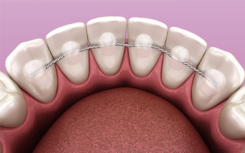 Retainer Behind Teeth retainer behind teeth