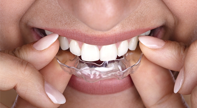 invisalign new york invisalign new york
